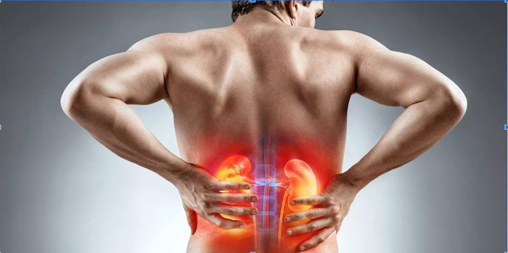 kidney stone symptoms