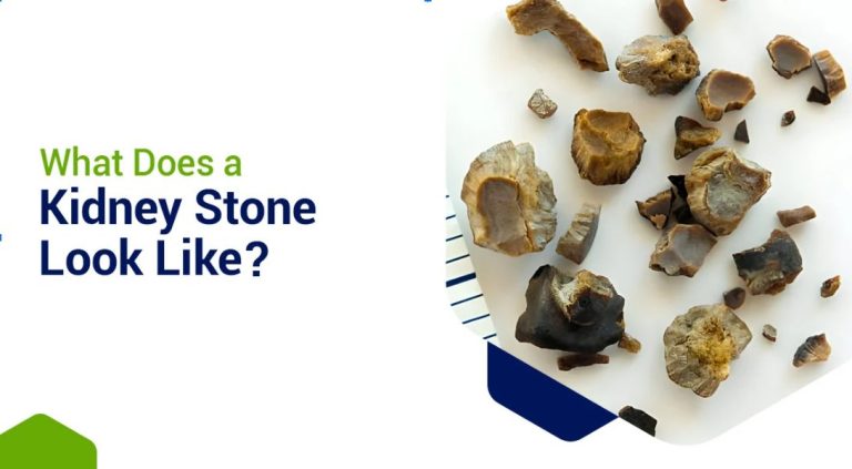 how do kidney stones look like
