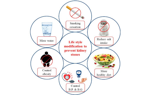 How to Dissolve Kidney Stones