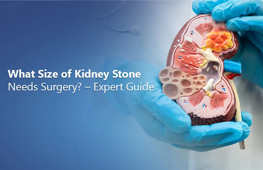 What Size of Kidney Stone Requires Surgery